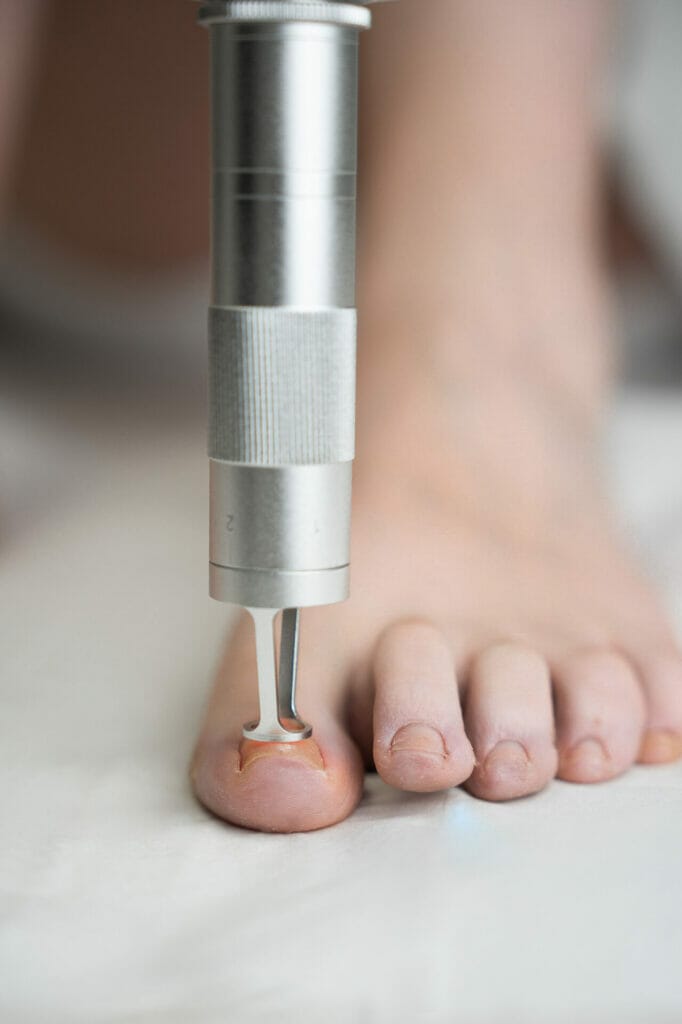 Onychomycosis (fungal nail) treatment - RH Laser Clinic