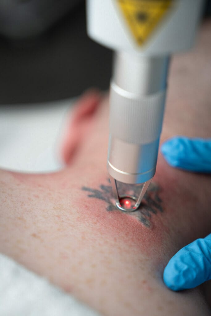 Tattoo & SPMU Removal - RH Laser Clinic