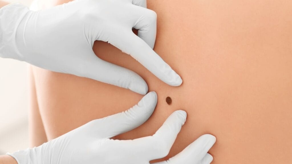 Map My Mole – Mole & Skin Lesion Checking Service